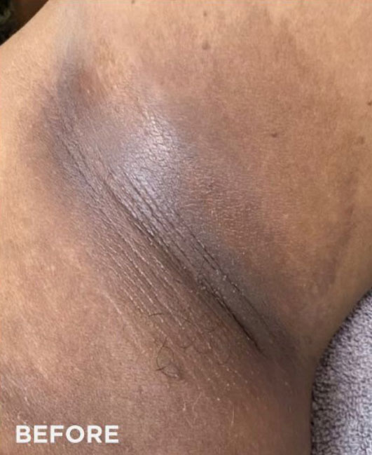 Chemical Peel, Vi peel, New York City Manhattan